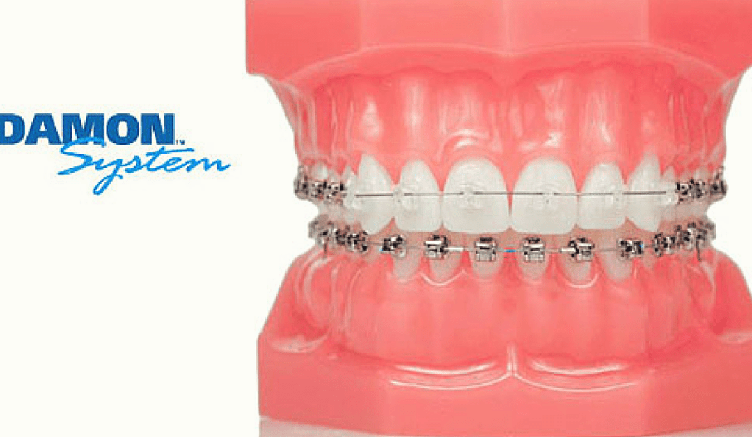 Your Guide To Different Types Of Braces – Damon Braces