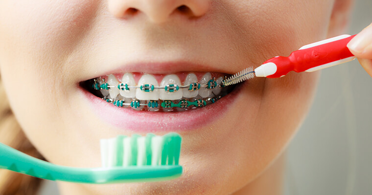 How to Brush and Floss with Braces