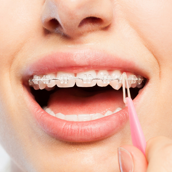 How to take care of your new braces?