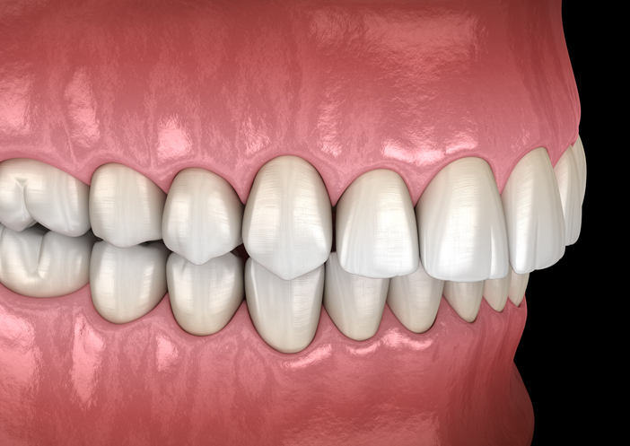 Overbite Teeth and Other Jaw Misalignments